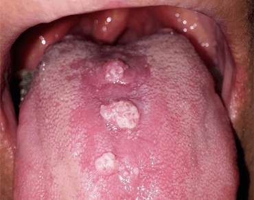 غربالگری-سریع-زگیل-HPV-دهانی