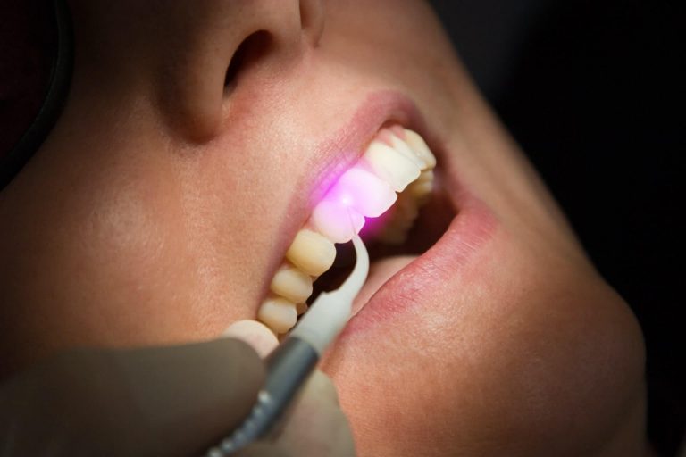 لیزر-در-دندانپزشکی